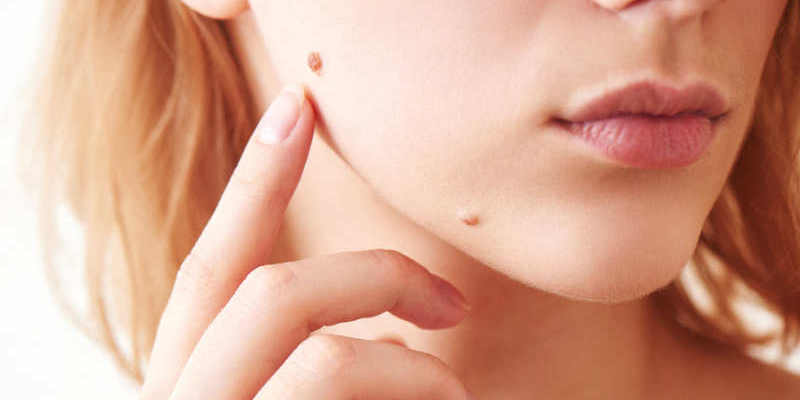 Benign Lumps And Bumps Laser Skin