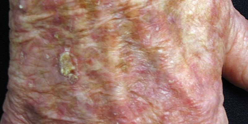 Skin Cancer And Pre Cancerous Lesions Laser And Skin